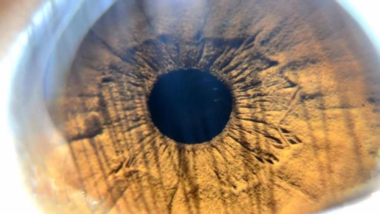 Göz rengini değiştiren yeni ameliyat trendi